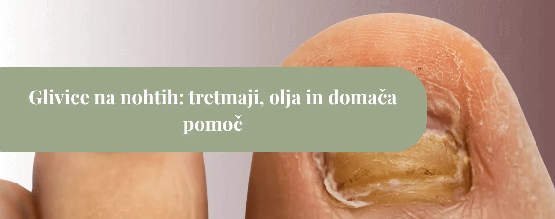 Prizadet noht na palcu na nogi z izrazito rumenkasto, zadebeljeno in spremenjeno nohtno ploščo, čez katero poteka zelen pas z napisom “Glivice na nohtih: tretmaji, olja in domača pomoč”.